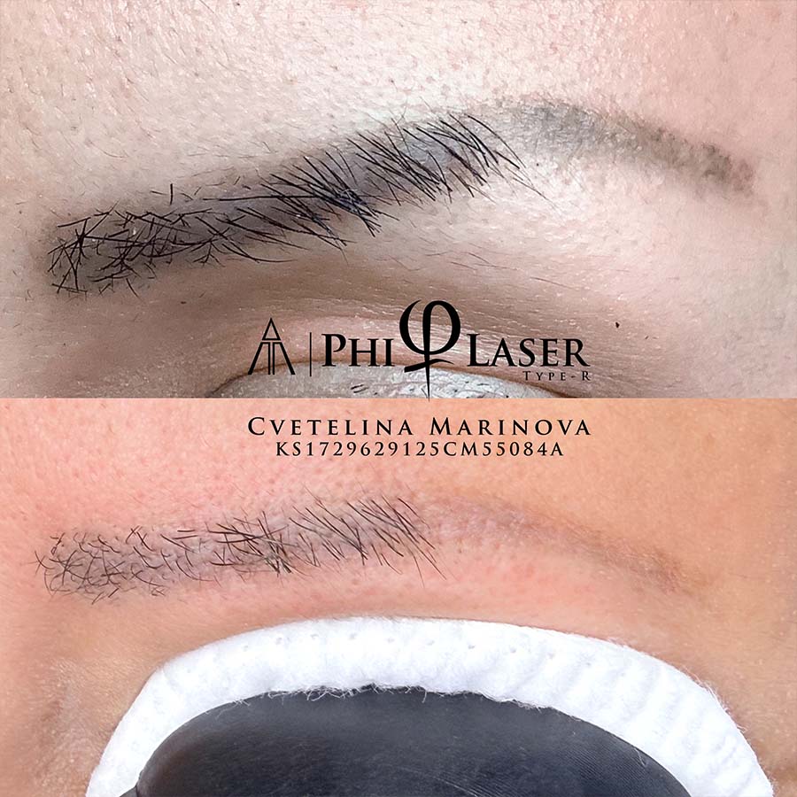 tattoo-removal-service-1 αφαιρεση τατουαζ ρεθυμνο