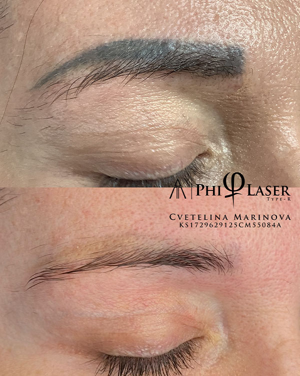 αφαιρεση τατουαζ κρητη